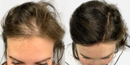 Les effets de la biotine sur les cheveux 